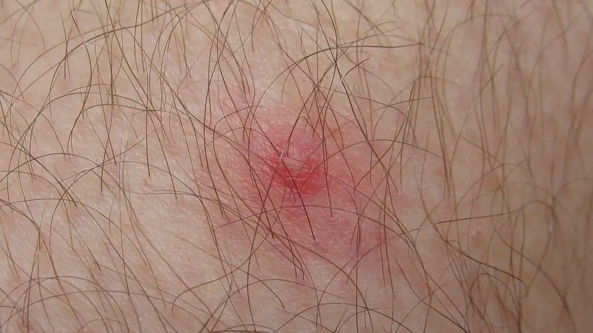 Site on skin where an attached tick was removed