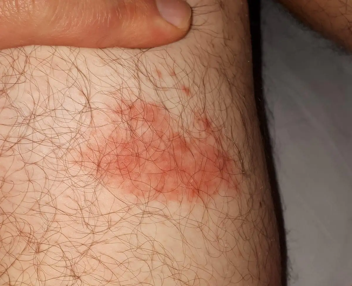 Solid red atypical Lyme rash without bull's-eye clearing
