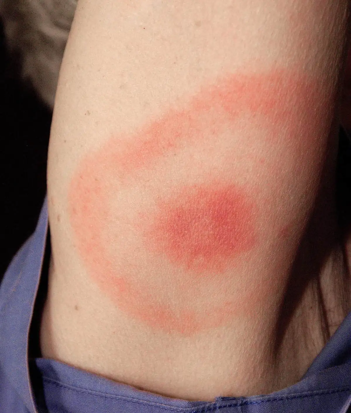 Bull's-eye shaped erythema migrans rash on skin